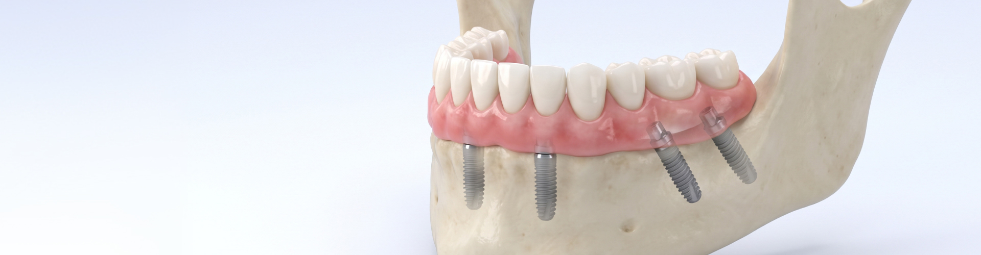 Model of a lower jawbone with dental implants and a arch of dentures.